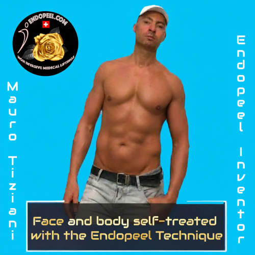 endopeel inventor self treated