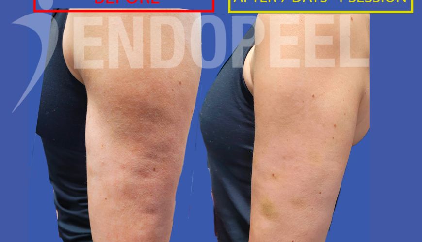 cellulite arm treated with endopeel