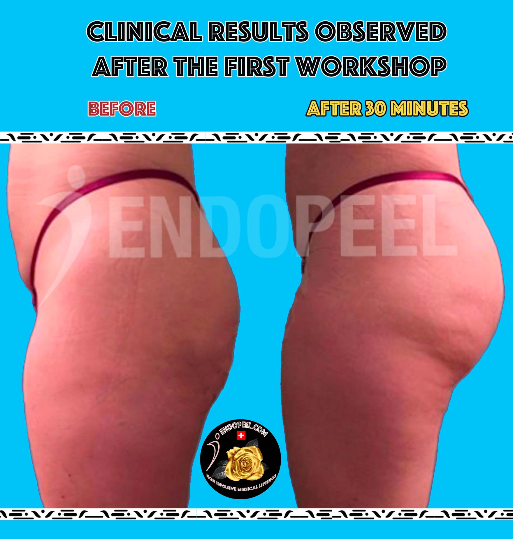 results after 1 st workshop gluteoplasty