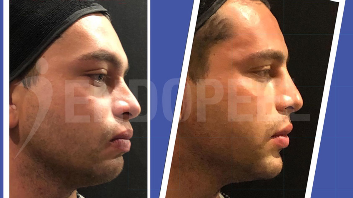 Endopeel advanced face and neck contouring before and after