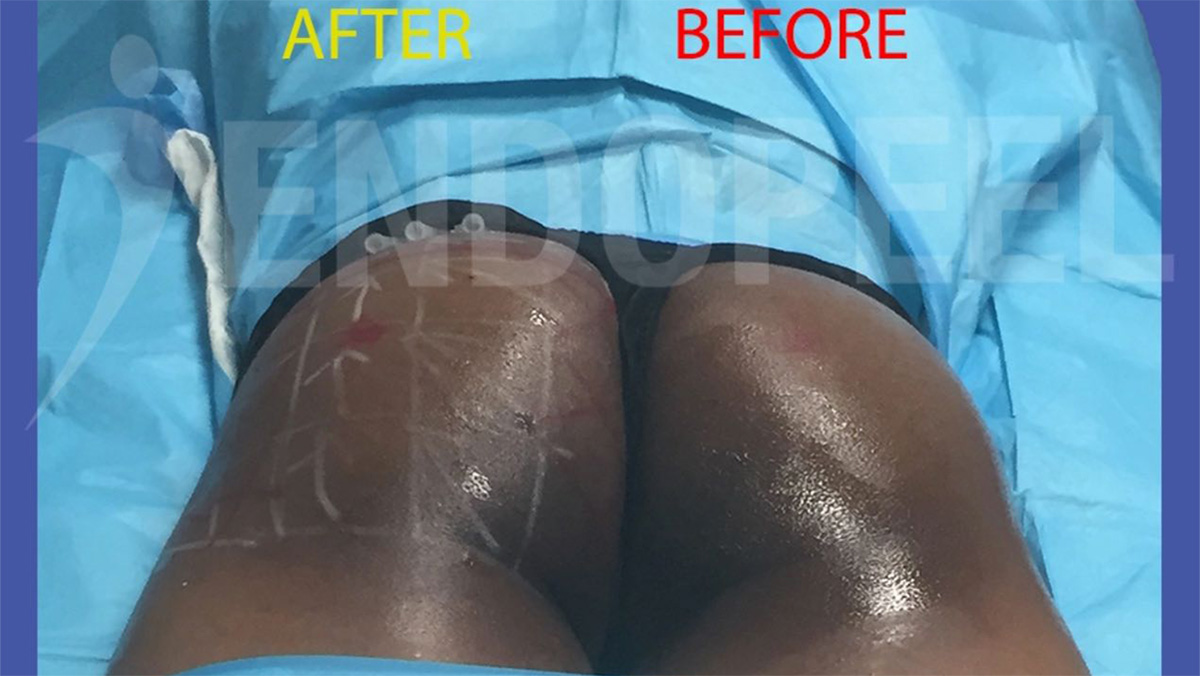 Endopeel buttocks contouring before and after