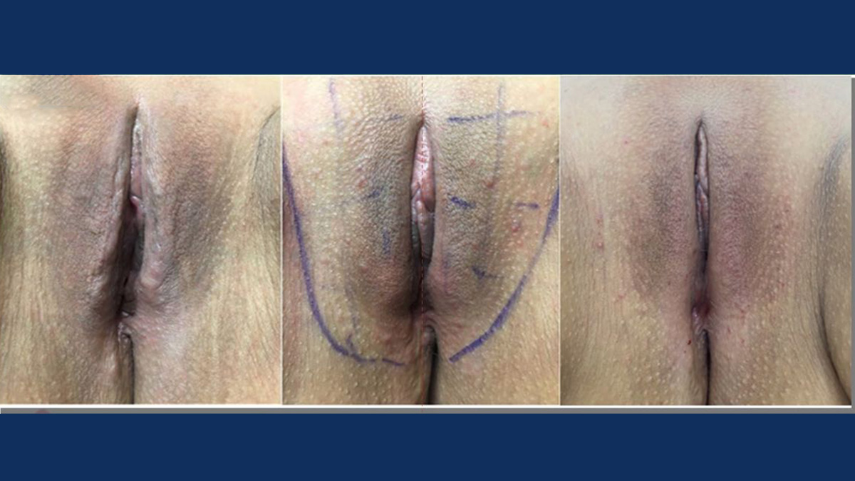 Endopeel gynecological remodeling clinical result