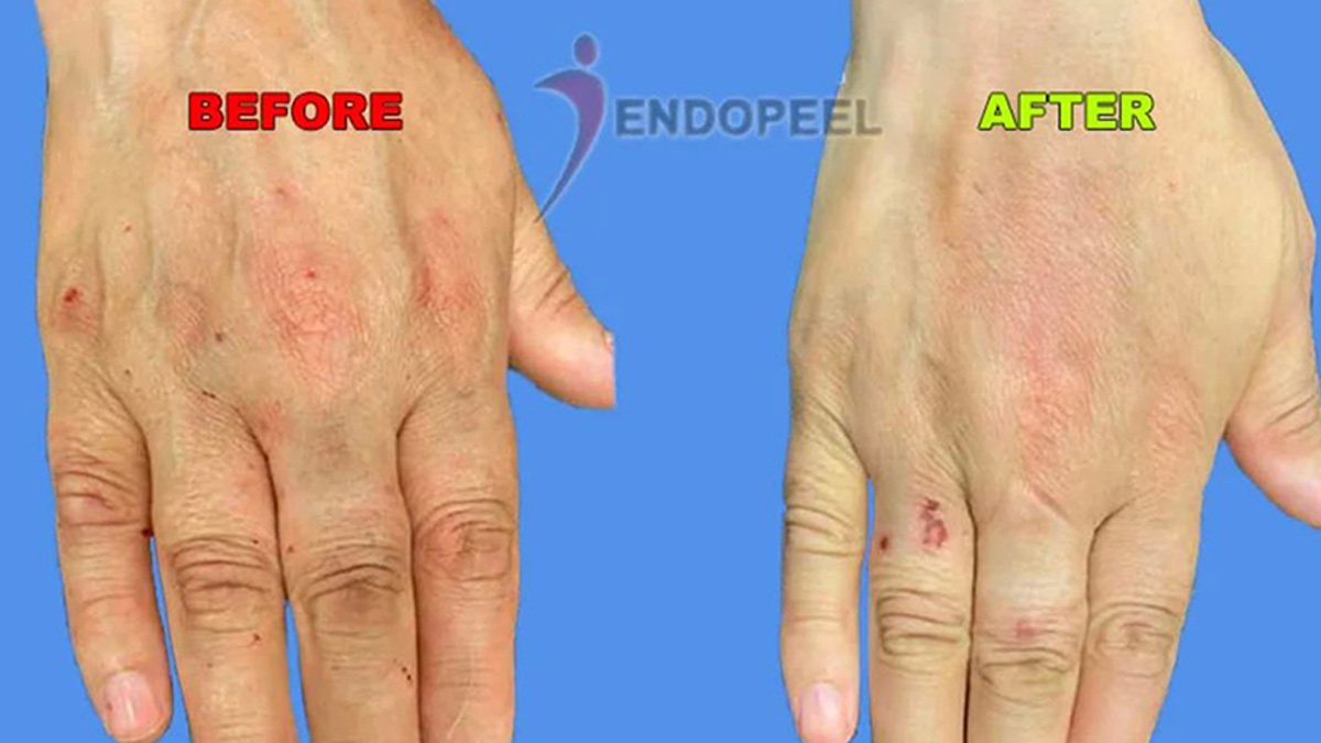 Endopeel hand rejuvenation before and after
