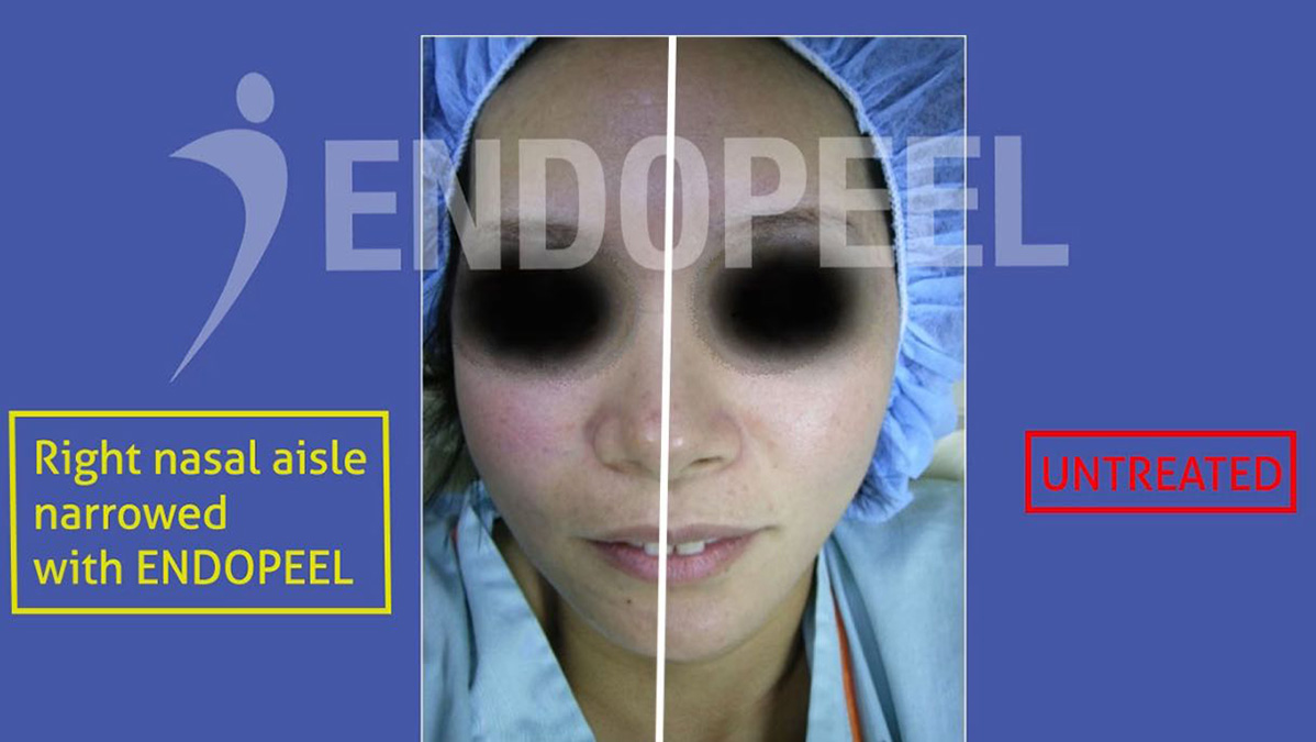 Endopeel nasal modulation and structural correction