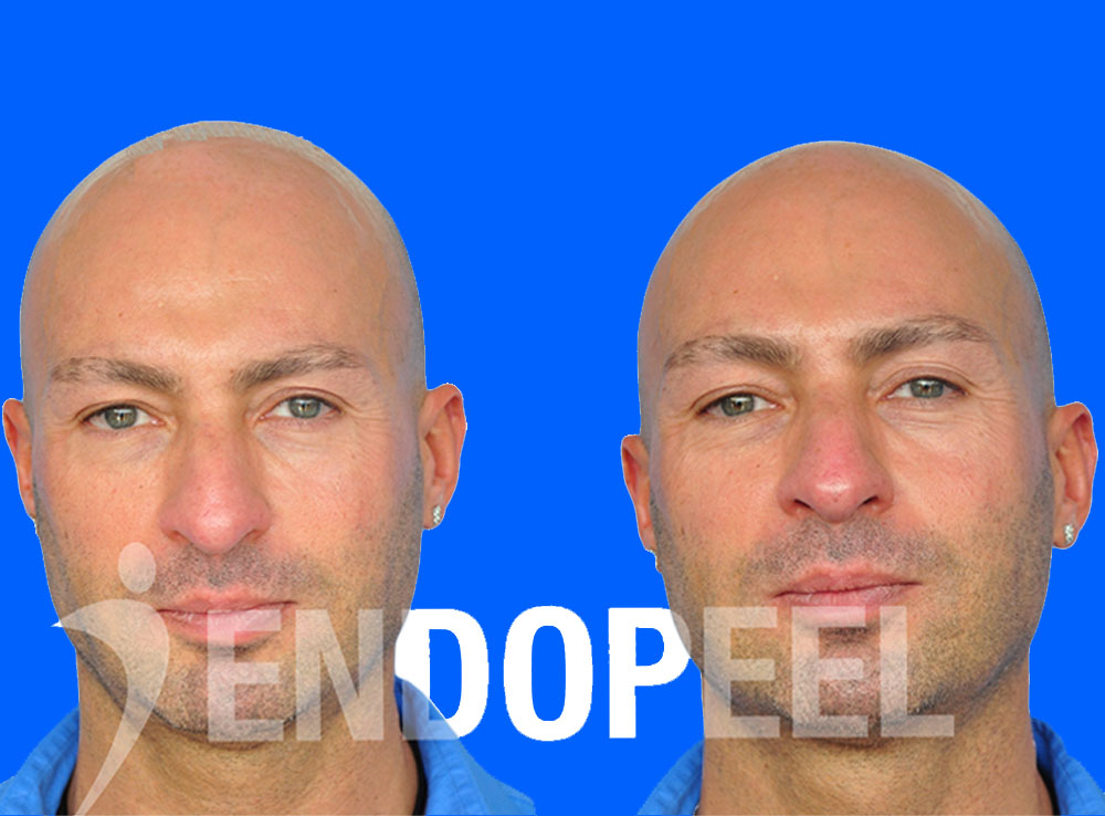 Medical rhinoplasty Endopeel training