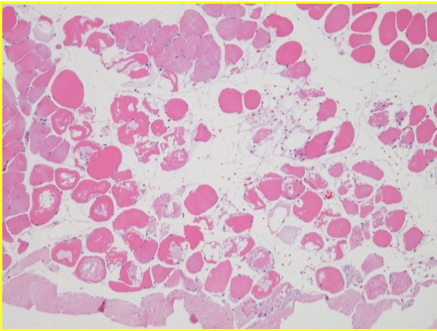 25 min post endopeel