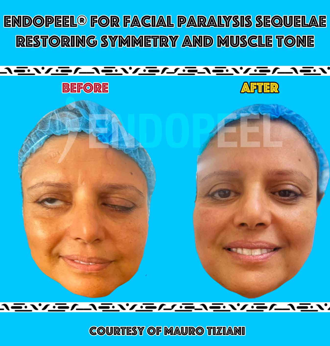 facial-paralysis facial-paralysis
