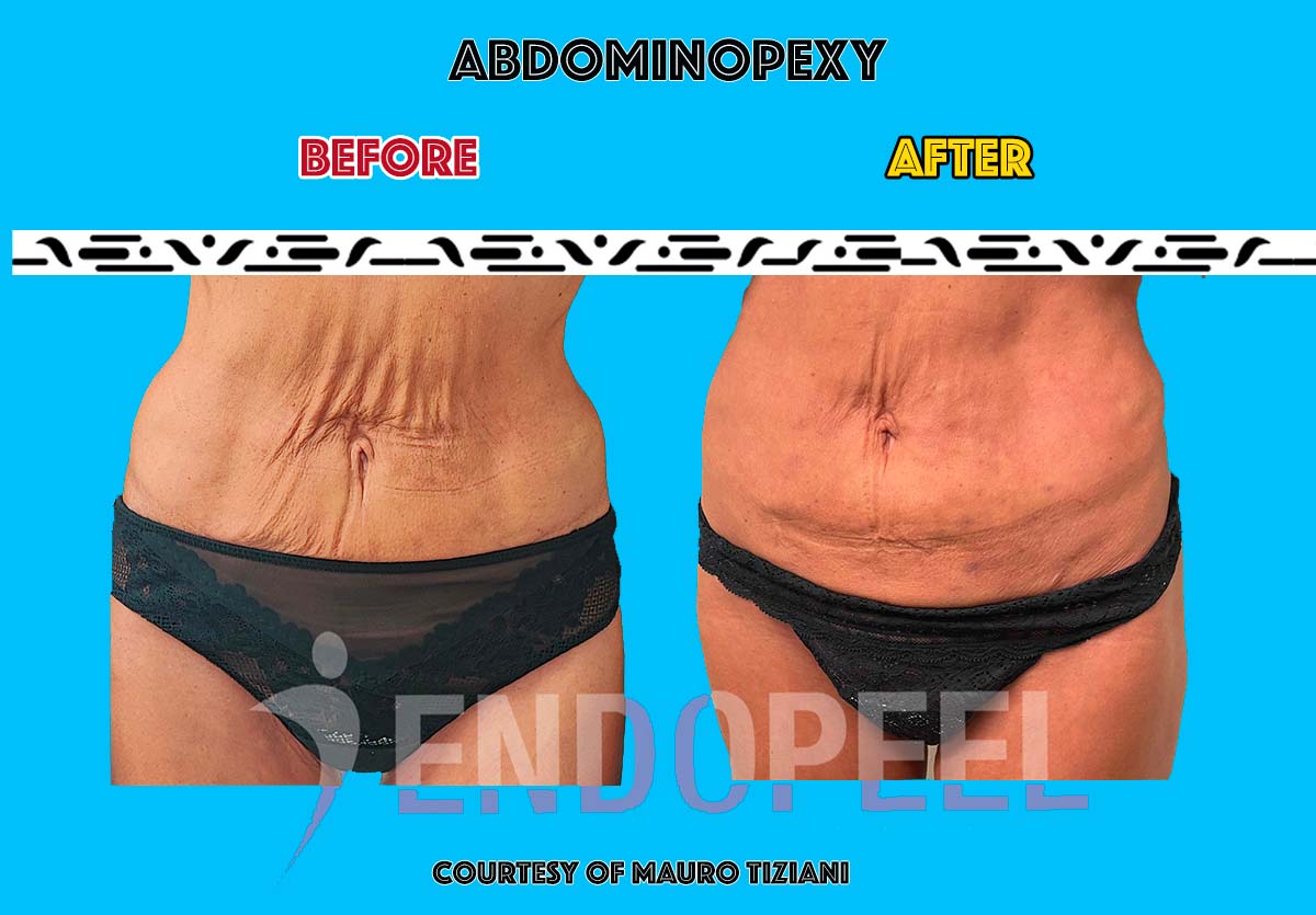 abdominoplasty abdominoplasty