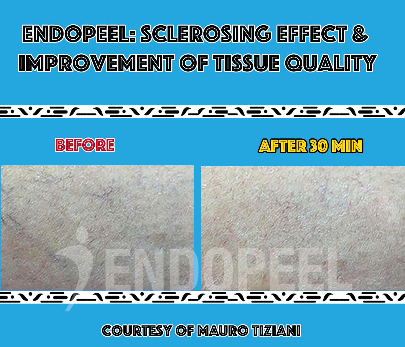 endopeel-sclerotherapy endopeel-sclerotherapy