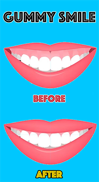 gummy-smile gummy-smile