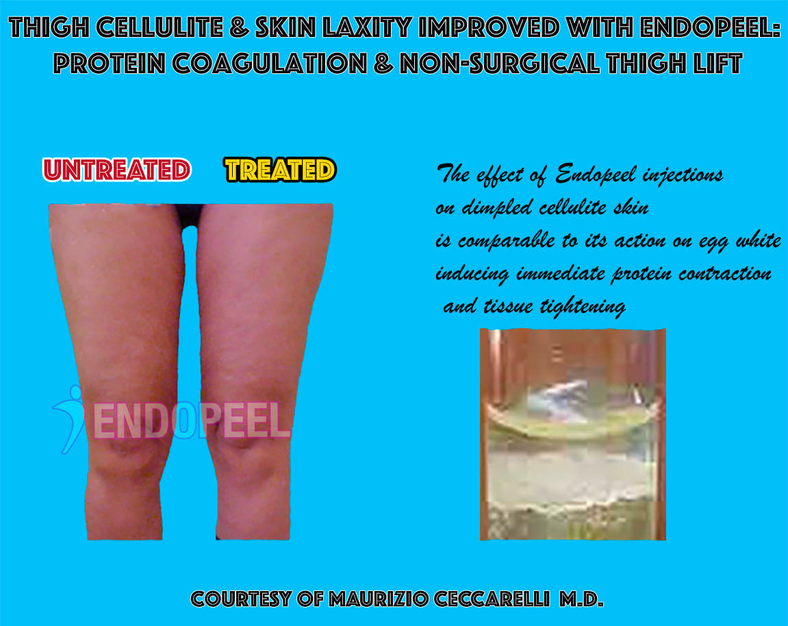 Clinical example of proteic coagulation in hypotonic subcutaneous tissues