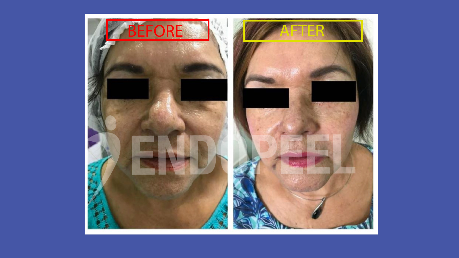 Clinical improvement of dark circles following Endopeel treatment