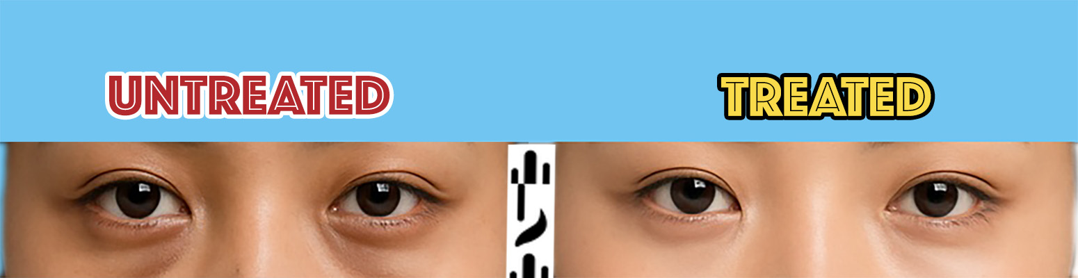 Clinical improvement of dark circles 