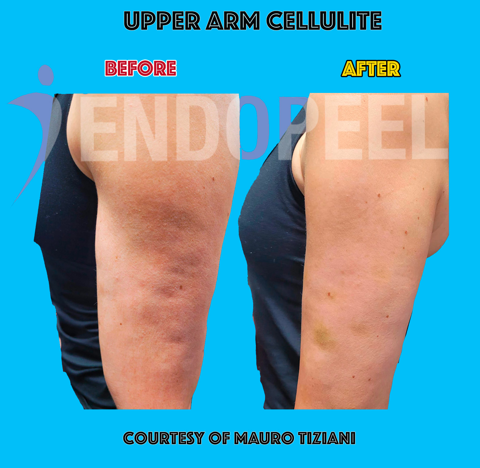 Endopeel treatment of cellulite demonstrating tissue structural support
