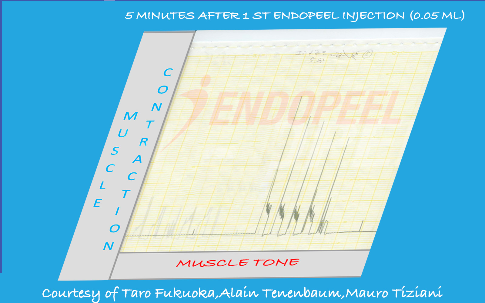 Muscle tracing five minutes after first 0.05 mL Endopeel® injection at a single point
