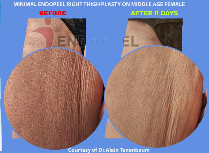 zoom plus post lipo right thigh plasty