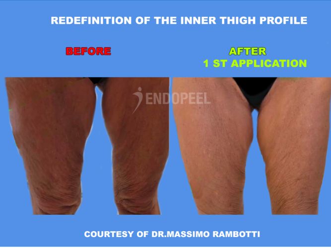 rambotti-inner-thighs-redefinition