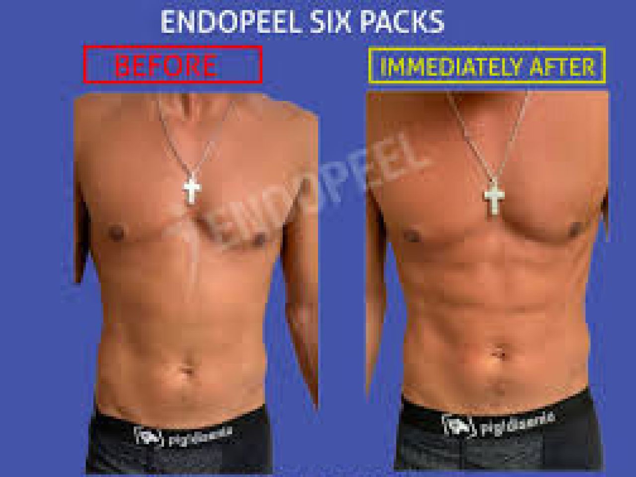 endopeel-six-packs