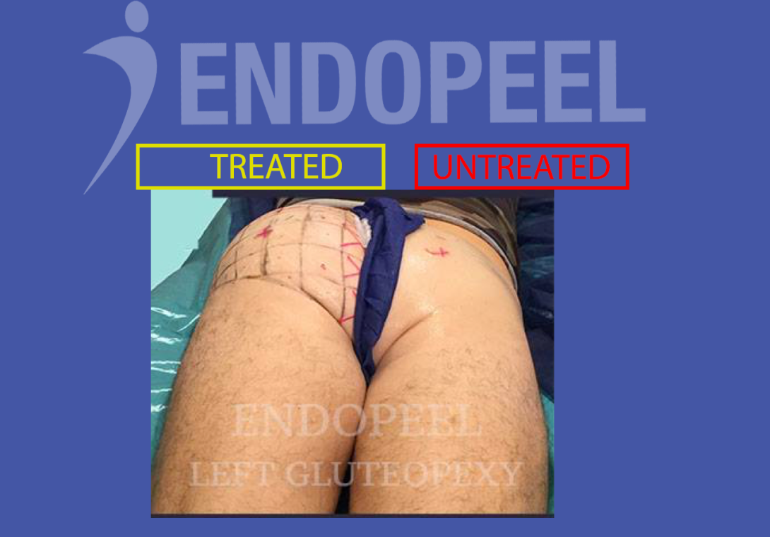 reshaping atrophic butts post trauma with Endopeel