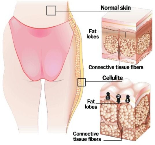 cellulite-physiopathology