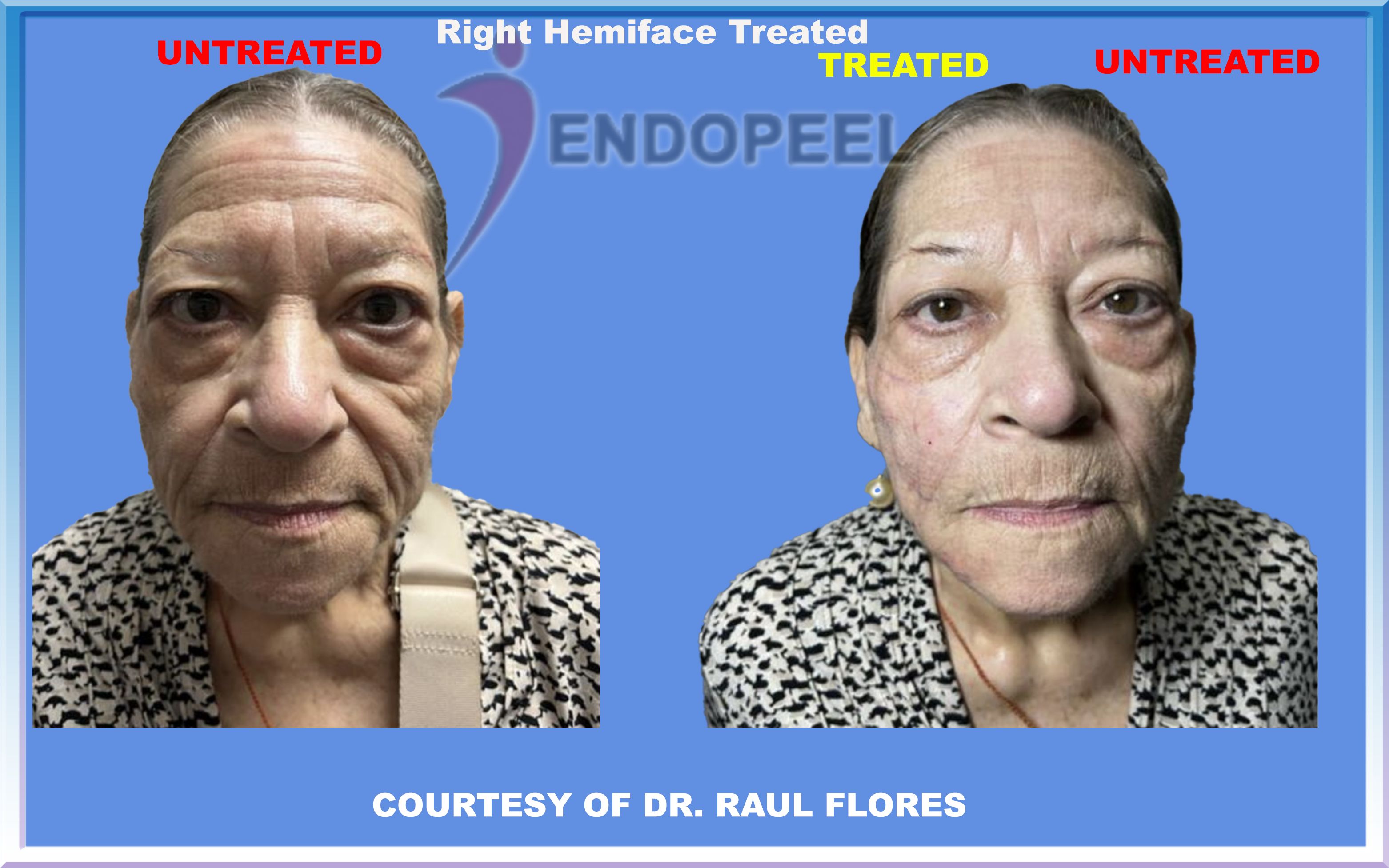 right hemiface treated by Dr.Raul Flores
